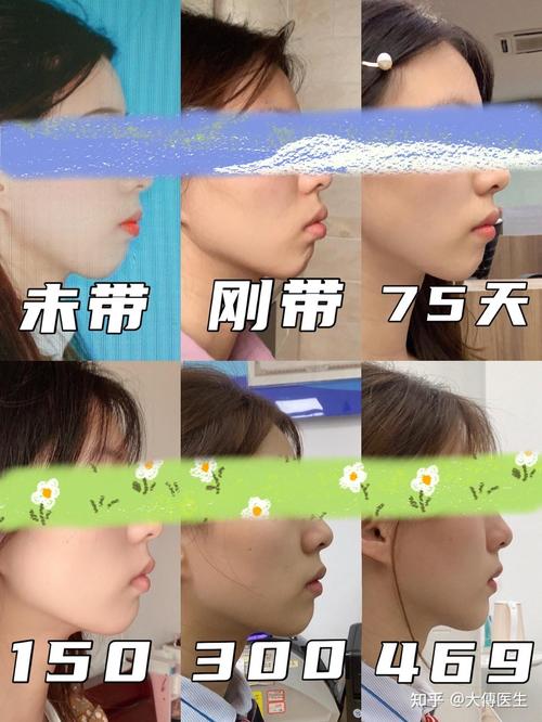 颧骨高可以矫正牙齿吗-图3