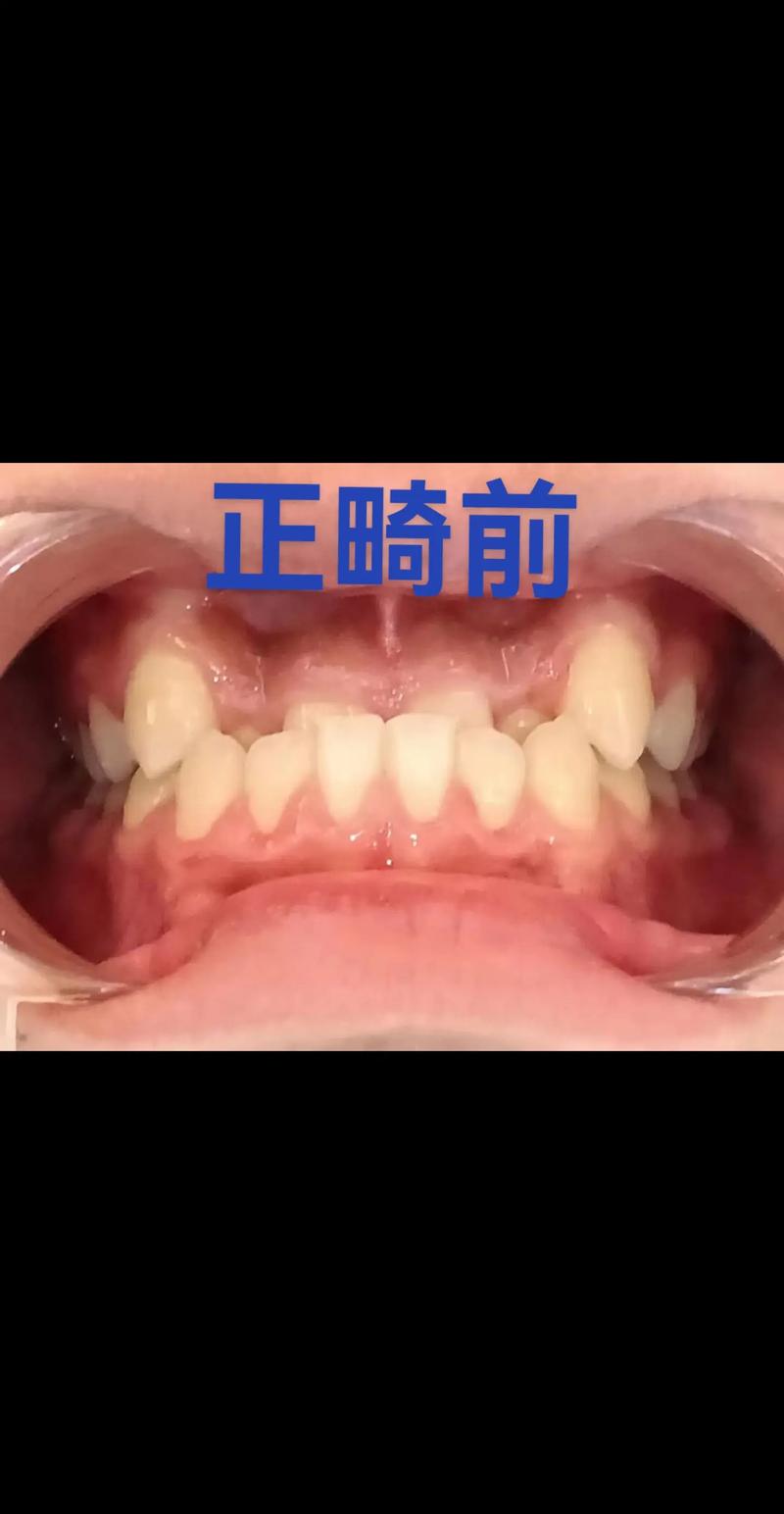牙齿前突矫正图片对比，前后变化到底有多明显？-图2