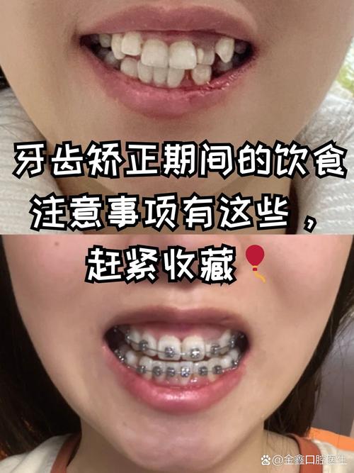 牙齿矫正疼不疼？专家详解疼痛程度与应对-图1