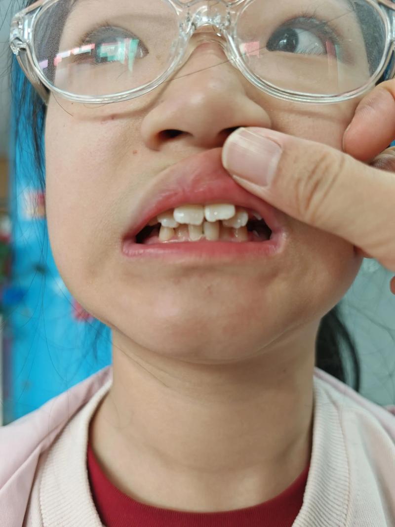 刚矫正牙齿吃不了东西,这是怎么回事?-图2 刚矫正牙齿吃不了东西,这是怎么回事?-图2