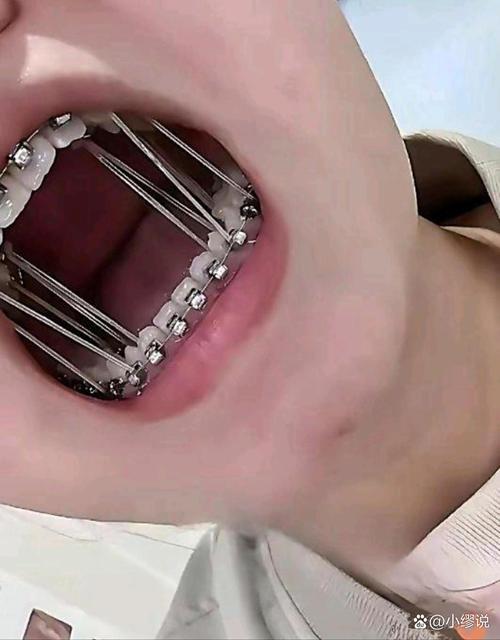刚矫正牙齿吃不了东西,这是怎么回事?-图1 刚矫正牙齿吃不了东西,这是怎么回事?-图1
