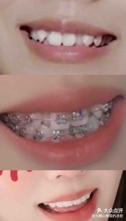 刚矫正牙齿吃不了东西,这是怎么回事?-图3 刚矫正牙齿吃不了东西,这是怎么回事?-图3