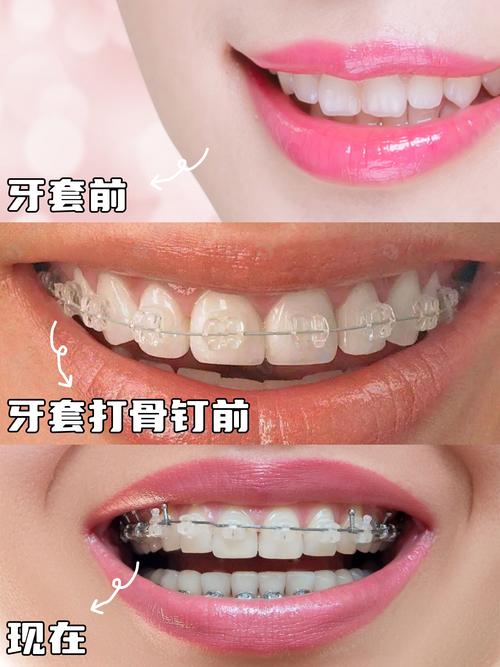 牙齿矫正期间，骨骼会经历怎样的变化过程？-图3