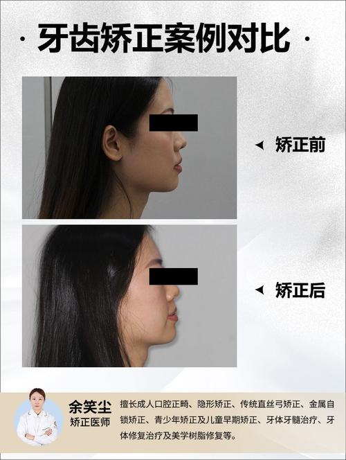 牙齿有点龅需要矫正吗？-图3