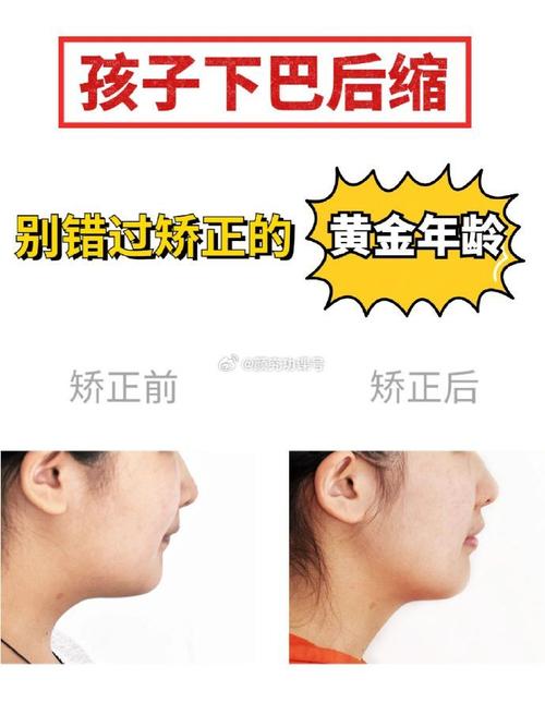 矫正牙齿改善下巴后缩-图2 矫正牙齿改善下巴后缩-图2