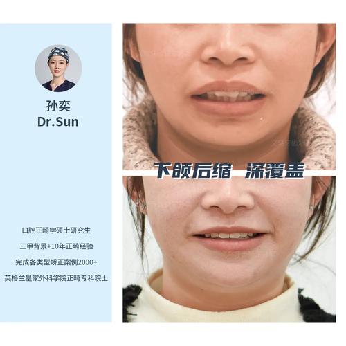 矫正牙齿改善下巴后缩-图1 矫正牙齿改善下巴后缩-图1