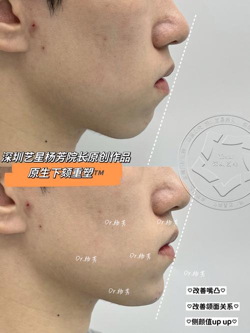 矫正牙齿改善下巴后缩-图3 矫正牙齿改善下巴后缩-图3