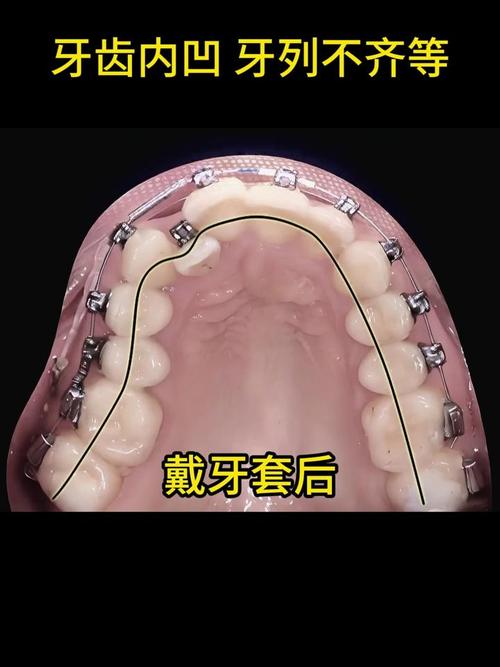 牙齿往内凹需要矫正吗-图1