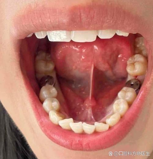 牙齿往内凹需要矫正吗-图2