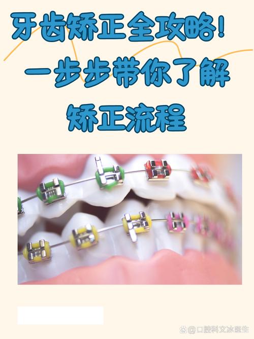 牙齿矫正牙缝怎么收？医生常用的收缝方法有哪些？-图3