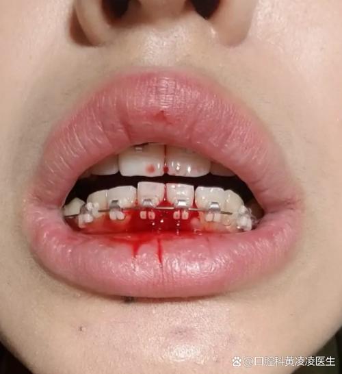 牙齿矫正期间牙龈出血-图2