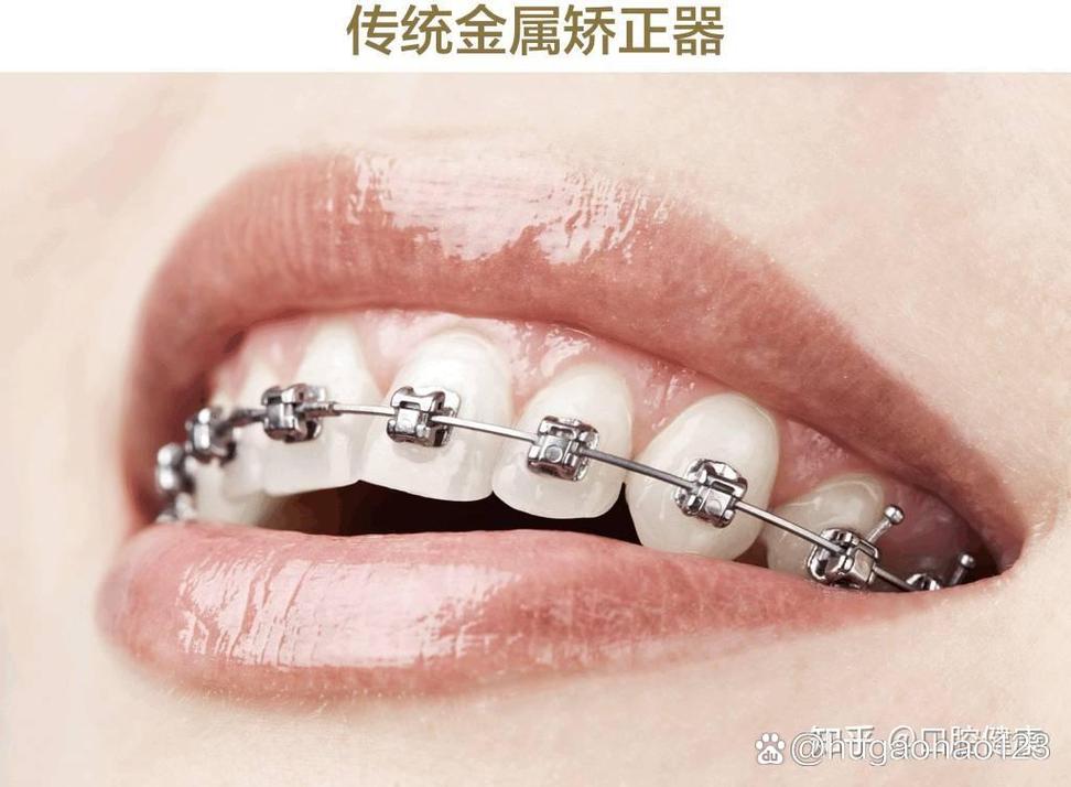 保定牙齿矫正去哪家好?靠谱机构怎么选?-图2 保定牙齿矫正去哪家好?靠谱机构怎么选?-图2