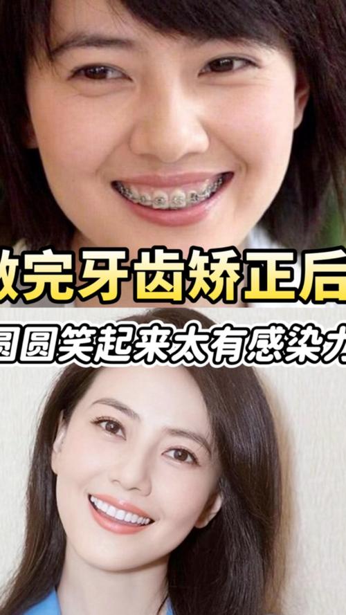 矫正牙齿后能改变笑容-图1
