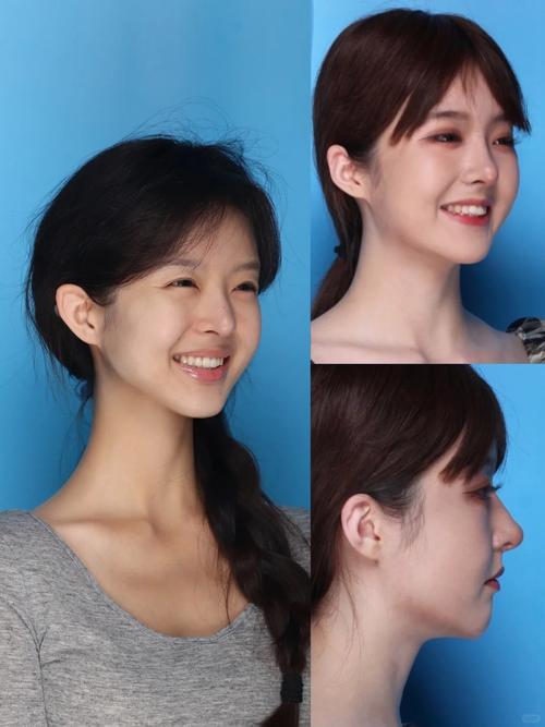 矫正牙齿后能改变笑容-图2