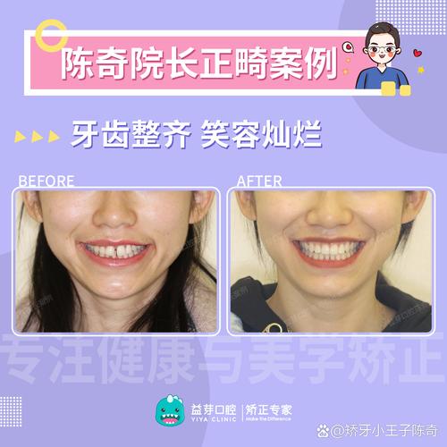 龙华医院有牙齿矫正服务吗?项目详情与流程解答-图1 龙华医院有牙齿矫正服务吗?项目详情与流程解答-图1