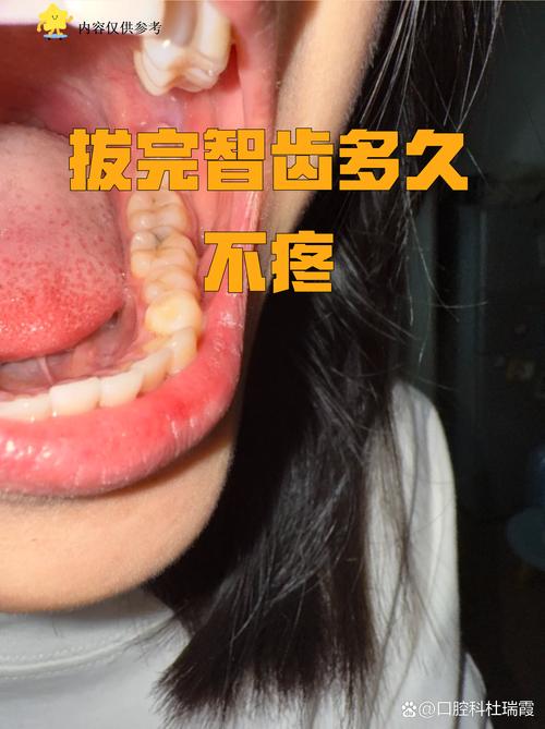 拔牙后矫正牙齿一般需要间隔多长时间才能开始矫正呢？-图2