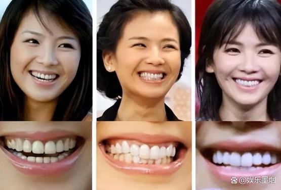 明星为何高龄矫正牙齿?晚矫正效果如何?-图3 明星为何高龄矫正牙齿?晚矫正效果如何?-图3