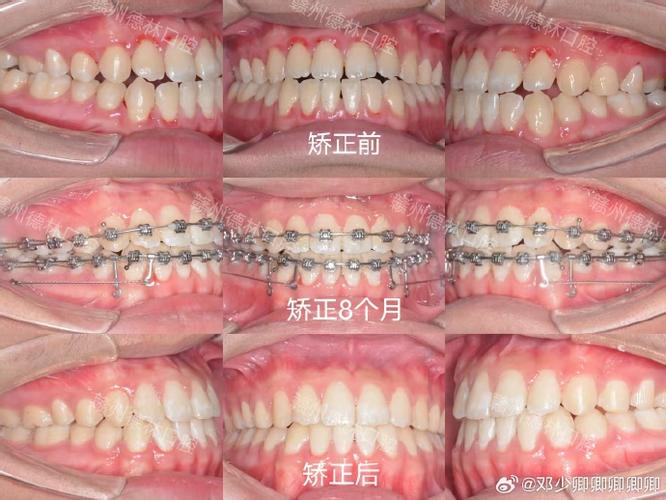 牙齿地包天矫正的地方-图3