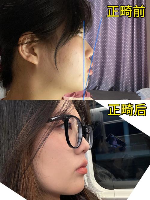 拔8颗牙齿矫正，图片效果真的能变美吗？-图1