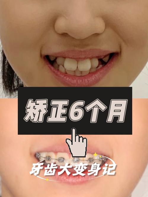 孩子矫正牙齿的最佳年龄是几岁?-图3 孩子矫正牙齿的最佳年龄是几岁?-图3
