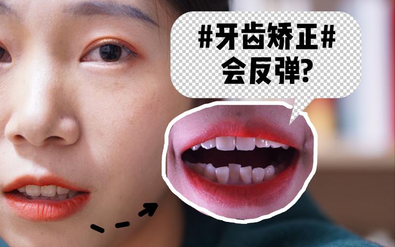 牙齿矫正后反弹的图片，如何判断反弹原因？预防方法有哪些？-图1