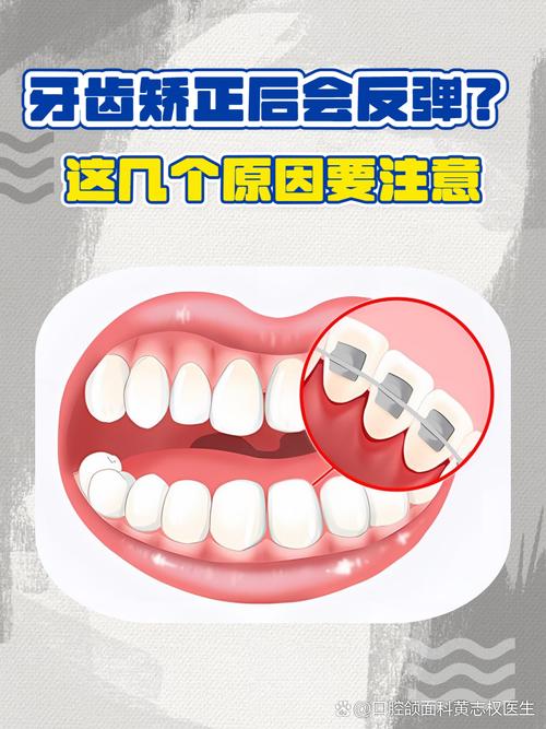 牙齿矫正后反弹的图片，如何判断反弹原因？预防方法有哪些？-图3