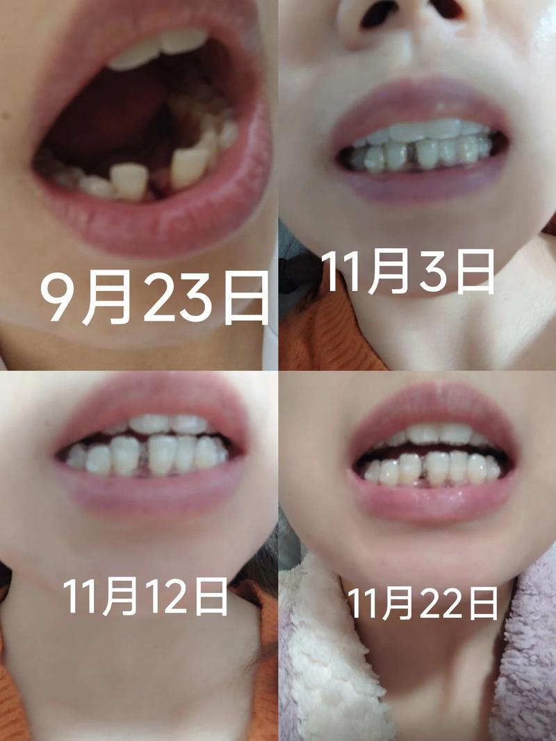 矫正拔牙后缝隙大，是什么原因？如何处理？-图2