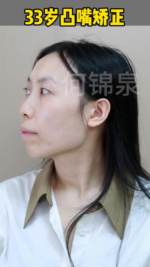 33岁矫正牙齿还来得及吗？成年人整牙可行吗？-图3