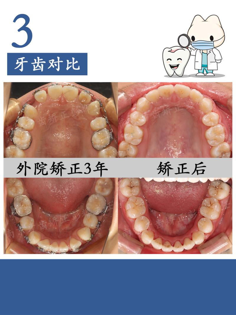 牙齿矫正最多拔几颗牙-图2