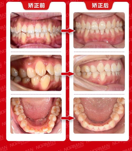 牙齿有点龅可以矫正吗？效果和周期怎么样？-图1
