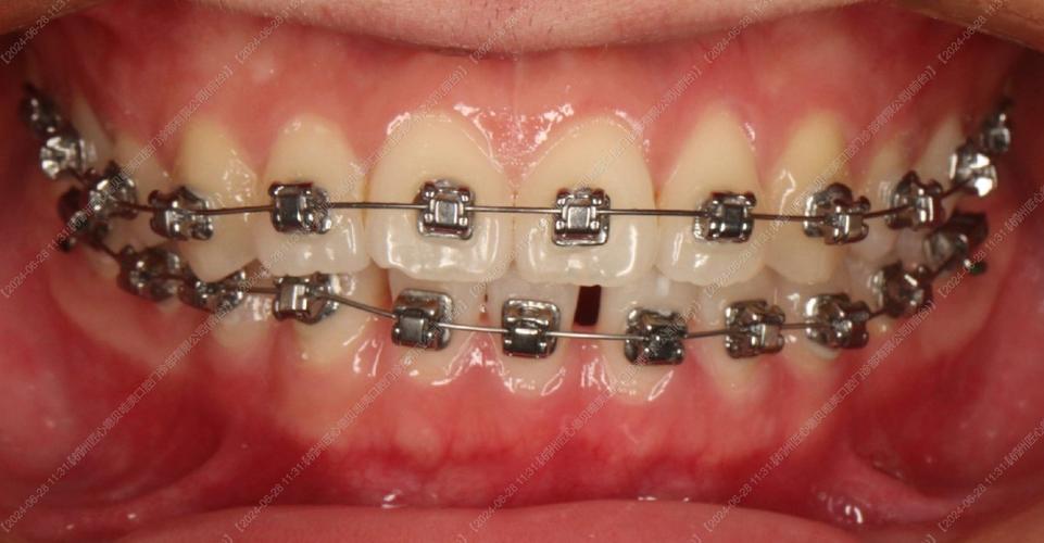 呼市矫正牙齿去哪儿做?靠谱机构推荐指南-图1 呼市矫正牙齿去哪儿做?靠谱机构推荐指南-图1