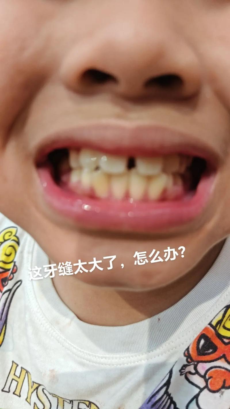 矫正牙齿期间牙缝变大是正常现象吗？-图2