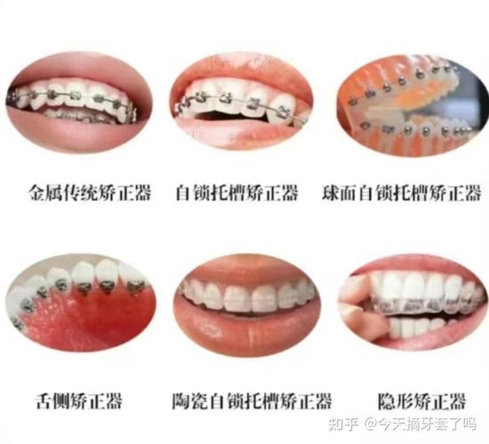 廊坊牙齿矫正哪里最好？求推荐靠谱好医院！-图3