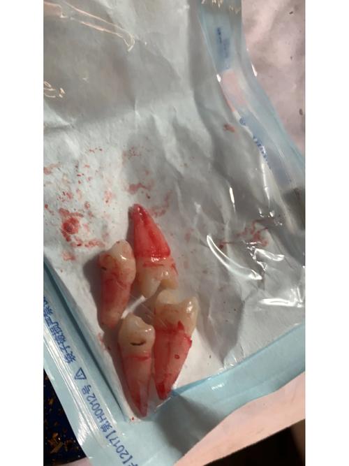 矫正牙齿拔了虎牙后悔-图1