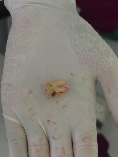 牙齿矫正后牙根出来了,是什么原因导致的?该如何处理?-图2 牙齿矫正后牙根出来了,是什么原因导致的?该如何处理?-图2