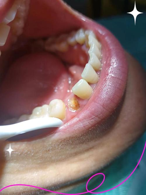 牙齿矫正后牙根出来了,是什么原因导致的?该如何处理?-图3 牙齿矫正后牙根出来了,是什么原因导致的?该如何处理?-图3