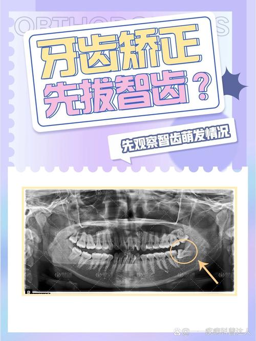 矫正牙齿智齿可以不拔吗？-图3