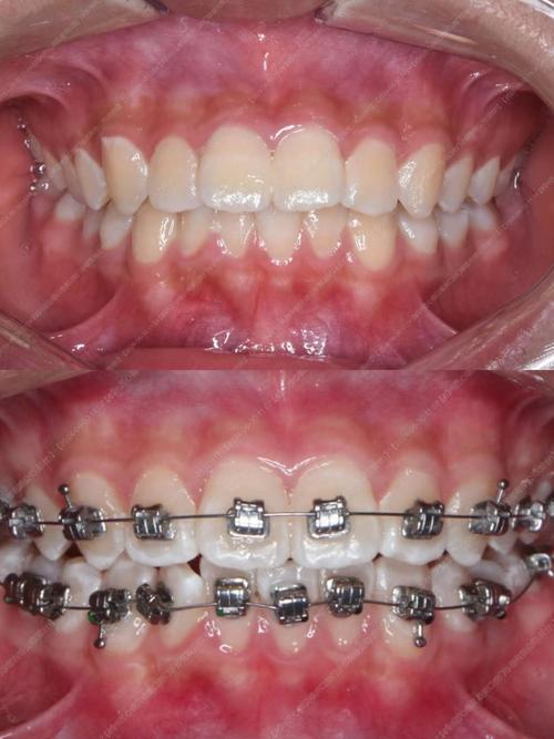 龅牙矫正牙齿移动视频，牙齿是如何一步步移动矫正的？-图2