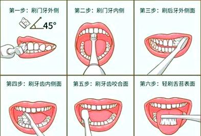 矫正牙齿期间，怎样刷牙才能既干净又不会损伤矫正器和牙龈？-图3
