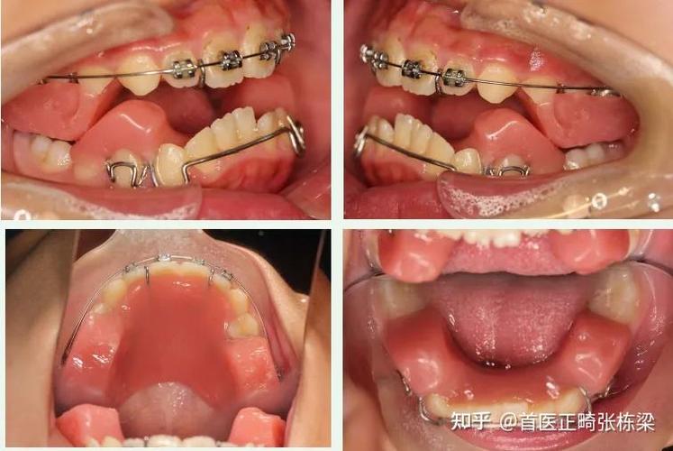 垫了下巴还能矫正牙齿-图1