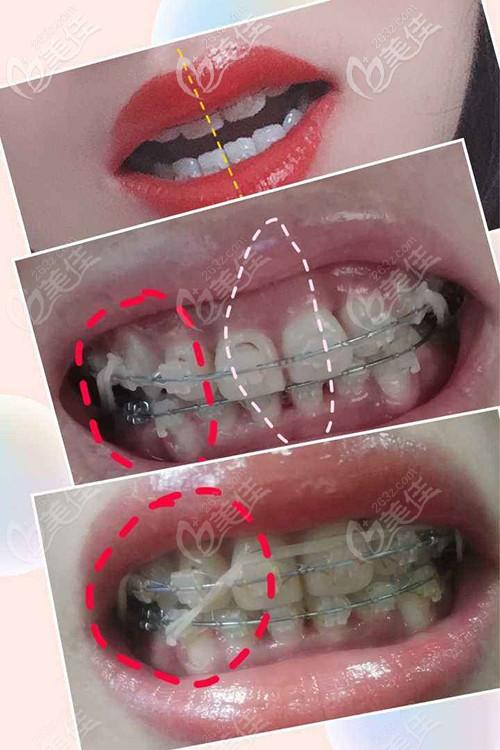牙齿矫正导致中线不齐-图1