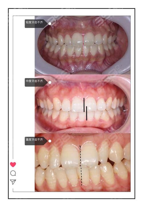 牙齿矫正导致中线不齐-图2