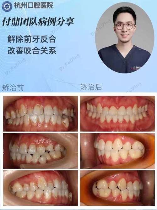 地包天矫正牙齿过程具体是怎样的？详细步骤有哪些？-图3