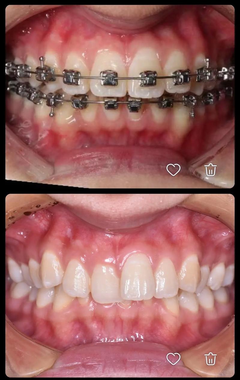 牙齿矫正为何不能频繁复诊？-图1