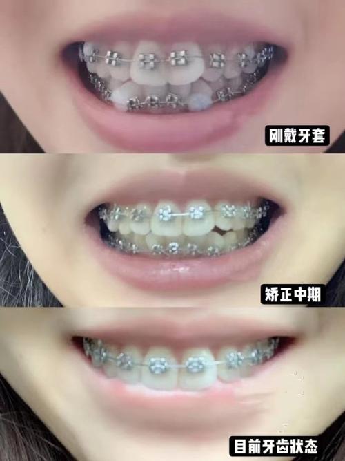 深圳矫正牙齿哪里找靠谱机构？-图2