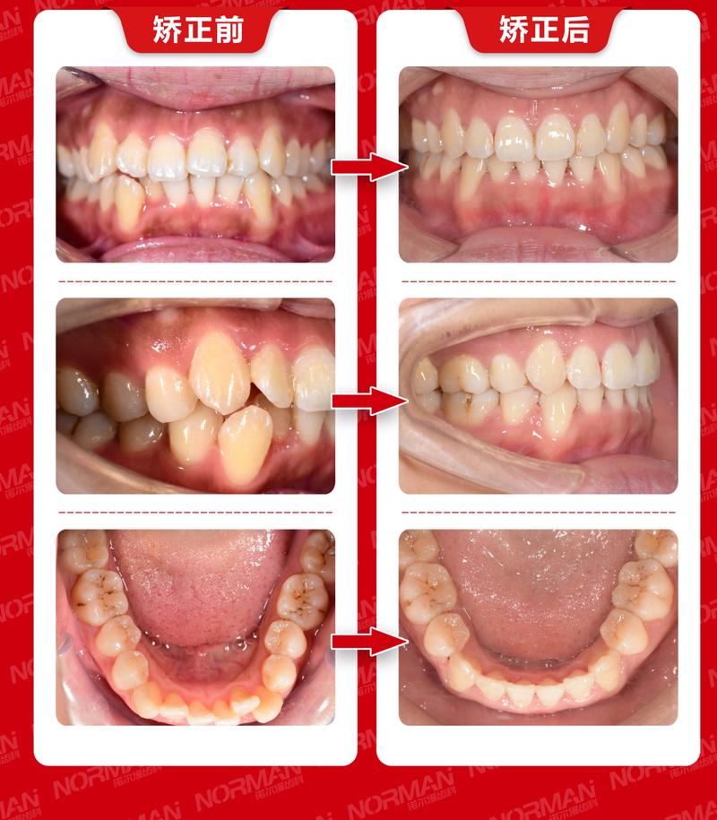 牙齿矫正照片前后对比-图1