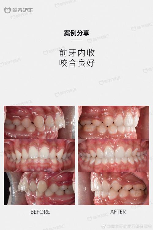 南京 矫正牙齿哪里好-图1 南京 矫正牙齿哪里好-图1