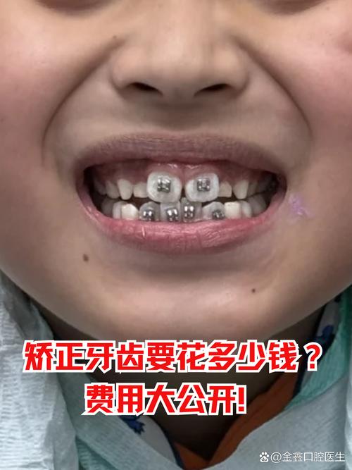 牙齿咬合不齐矫正,最佳矫正年龄究竟是什么时候?-图2 牙齿咬合不齐矫正,最佳矫正年龄究竟是什么时候?-图2