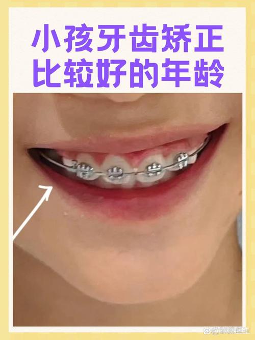 小孩矫正牙齿的最佳年龄是几岁?-图2 小孩矫正牙齿的最佳年龄是几岁?-图2