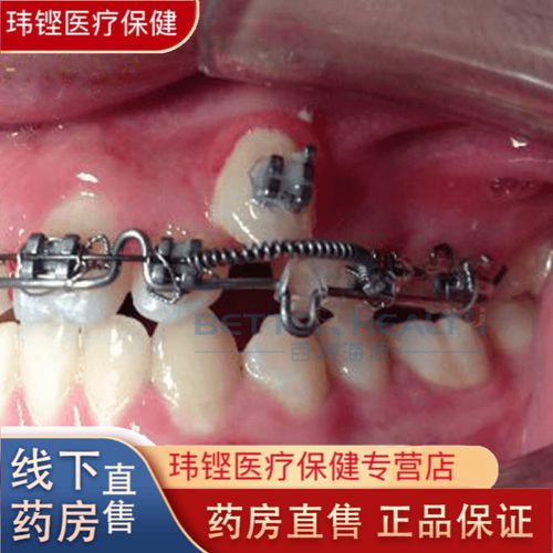矫正牙齿要带多久弹簧-图2 矫正牙齿要带多久弹簧-图2